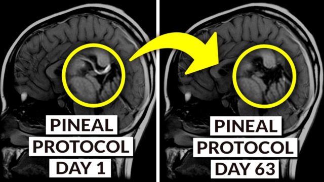 ついに松果体の脱灰方法が判明しました。